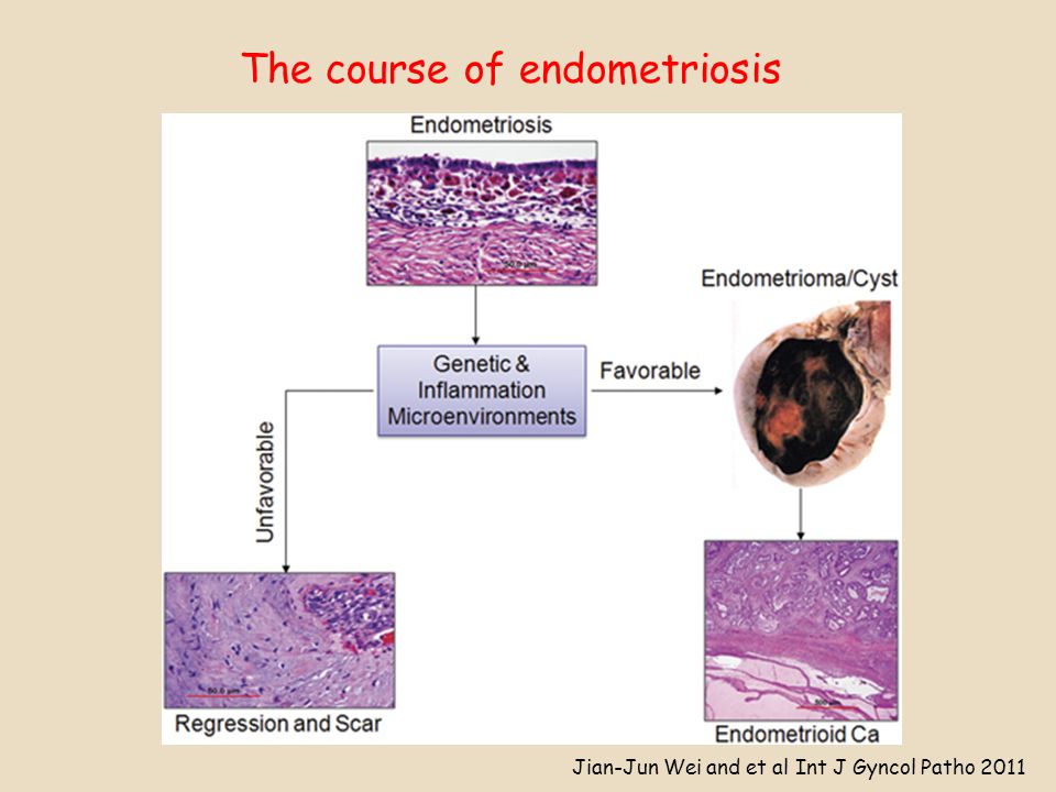 The course of endometriosis Jian-Jun Wei and et al Int J Gyncol Patho 2011