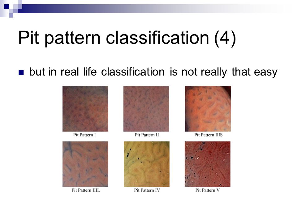 Pit pattern classification (4) but in real life classification is not really that easy