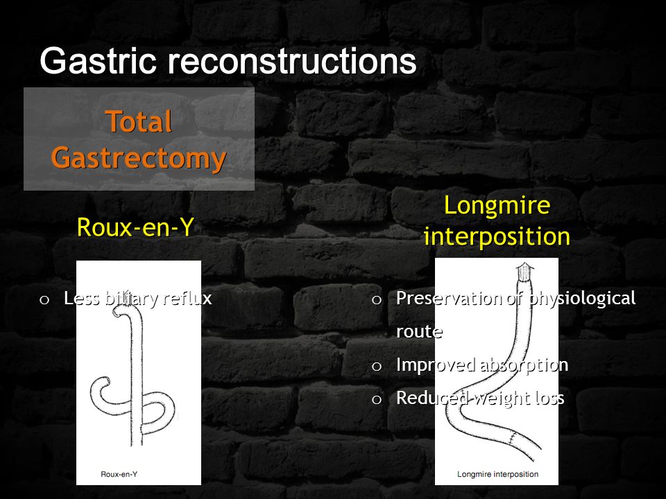 Gastric reconstructions Total Gastrectomy Roux-en-Y Longmire interposition o Less biliary reflux o Preservation of physiological route o Improved absorption o Reduced weight loss