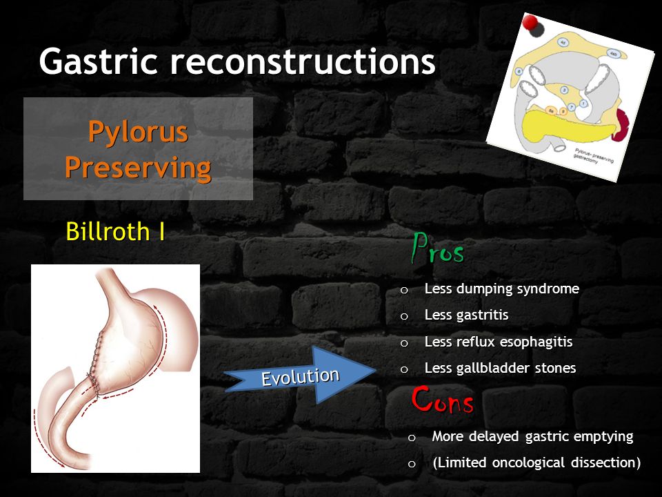 Pylorus Preserving Billroth I Evolution o Less dumping syndrome o Less gastritis o Less reflux esophagitis o Less gallbladder stones o More delayed gastric emptying o (Limited oncological dissection) Pros Cons