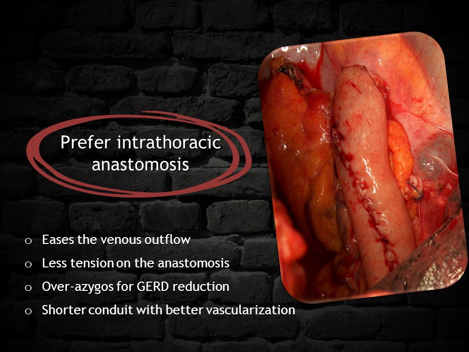 Prefer intrathoracic anastomosis o Eases the venous outflow o Less tension on the anastomosis o Over-azygos for GERD reduction o Shorter conduit with better vascularization