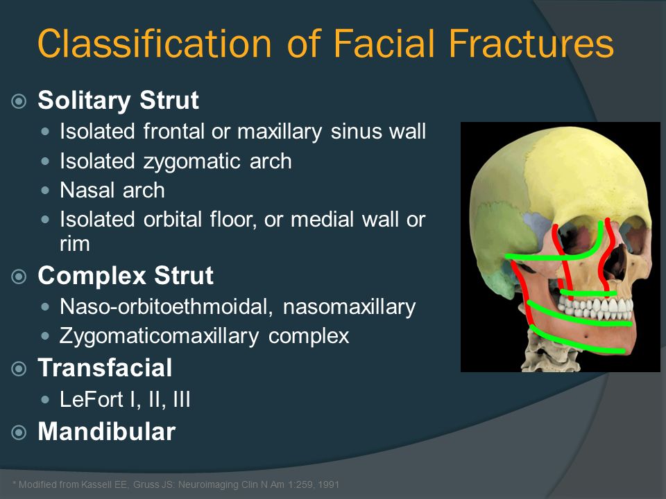 Facial fracture classification galleries 102