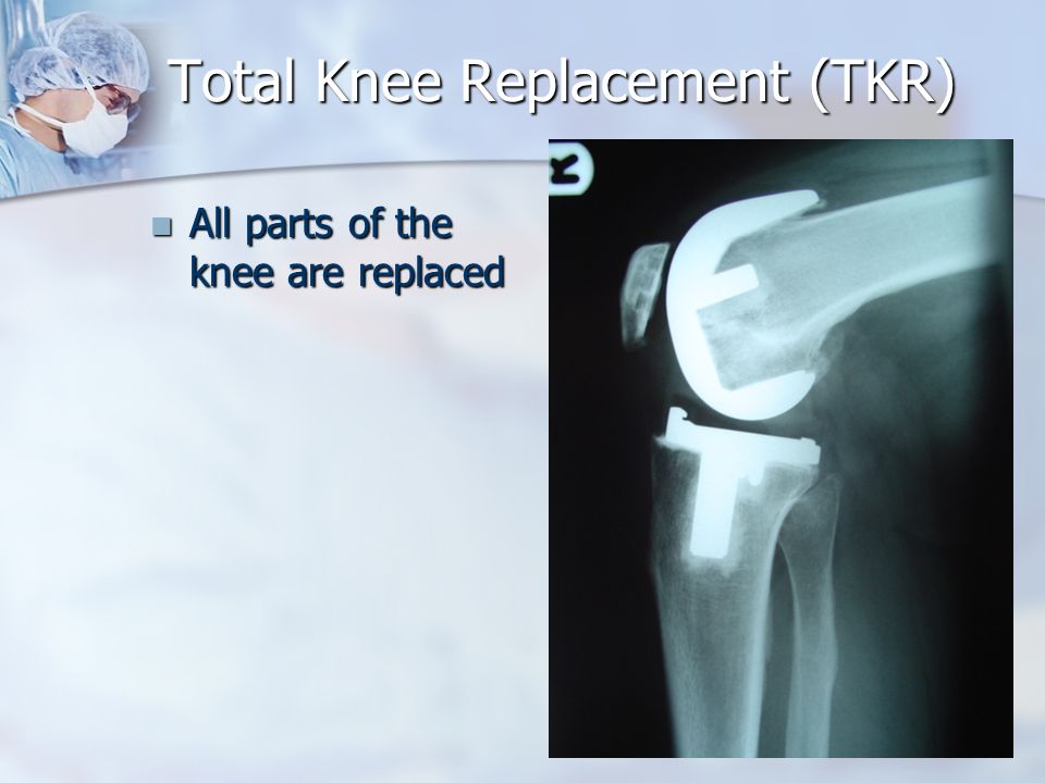 Total Knee Replacement (TKR) All parts of the knee are replaced All parts of the knee are replaced