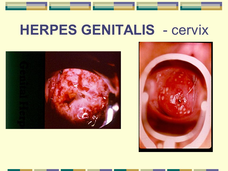 All Internal vaginal herpes symptoms Internal vaginal herpes symptoms
