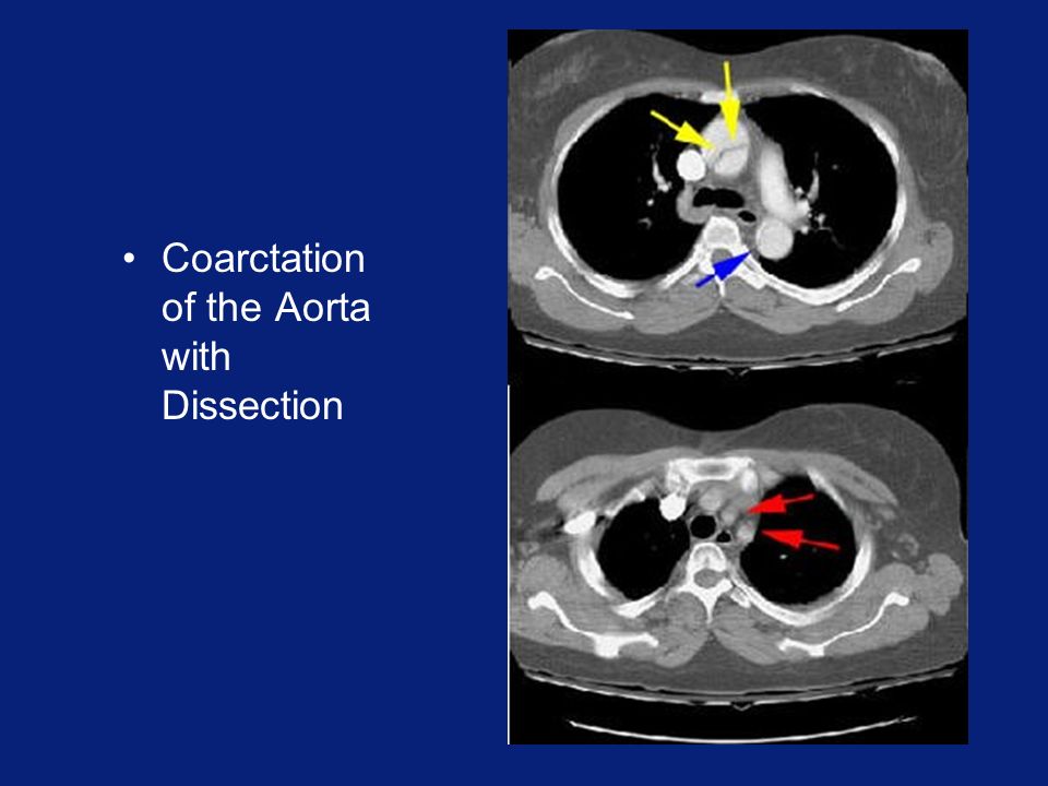 Coarctation of the Aorta with Dissection