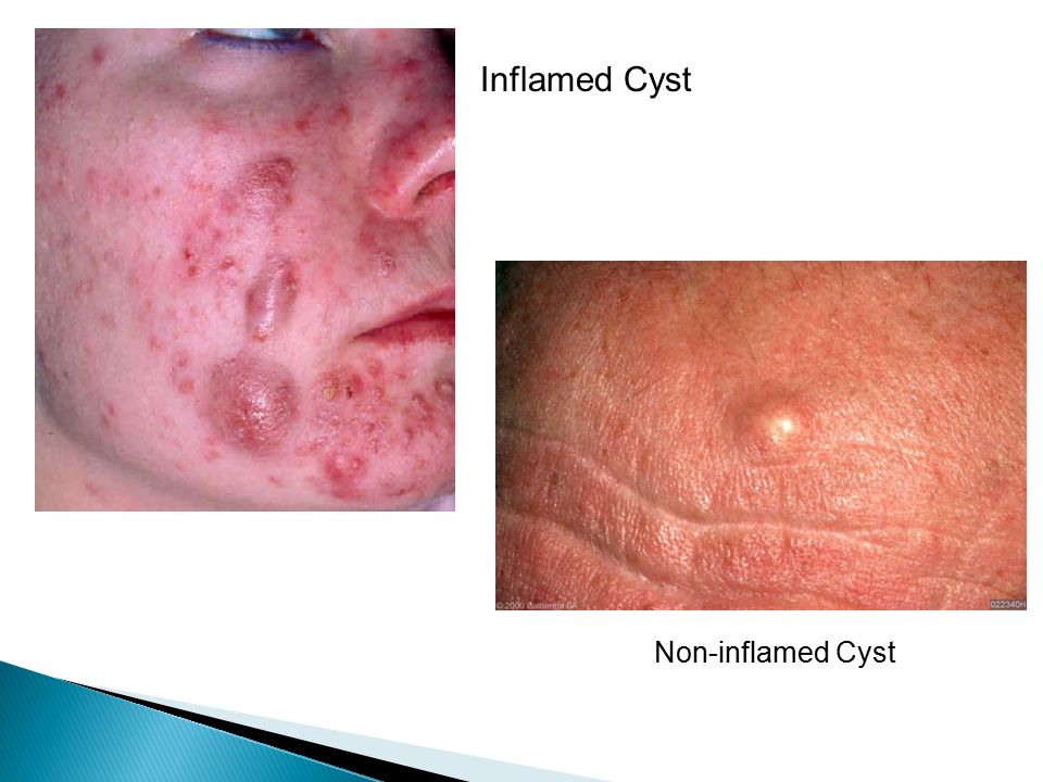 Inflamed Cyst Non-inflamed Cyst
