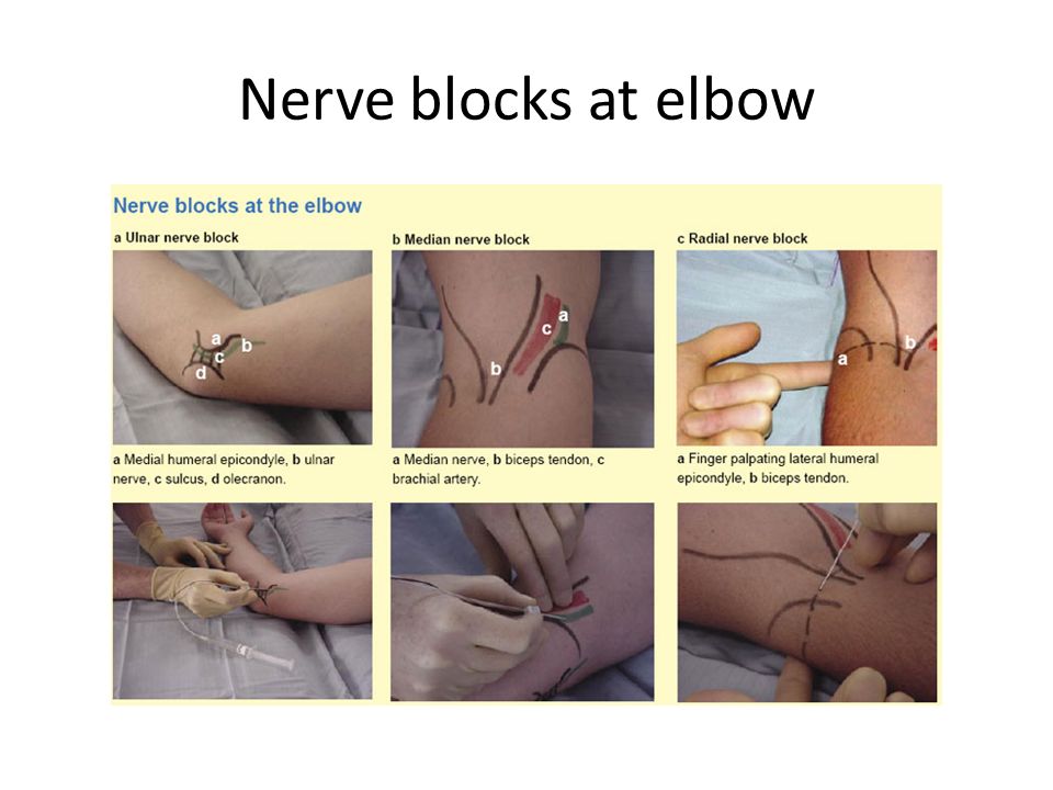 Nerve blocks at elbow