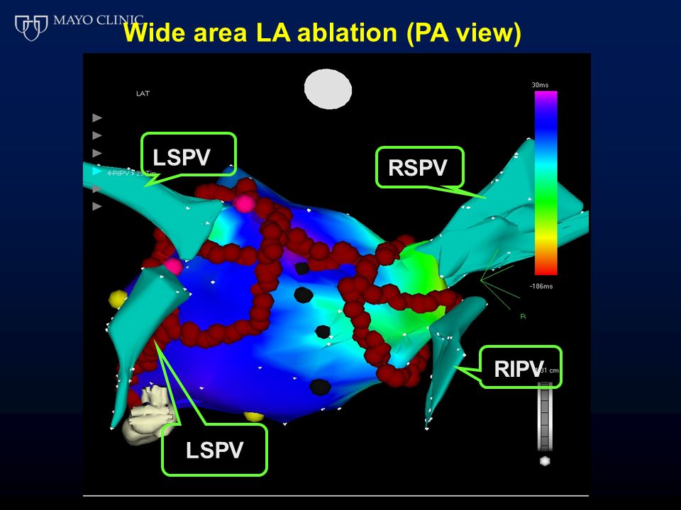 Wide area LA ablation (PA view) RSPV LSPV RIPV LSPV