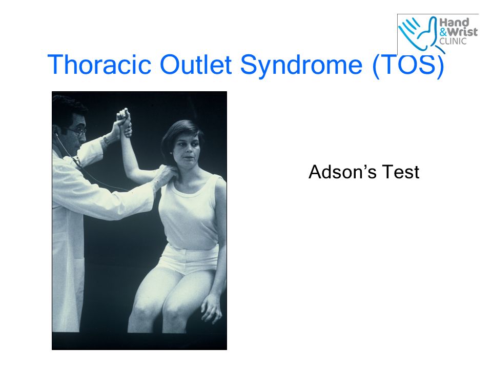 21 Thoracic Outlet Syndrome