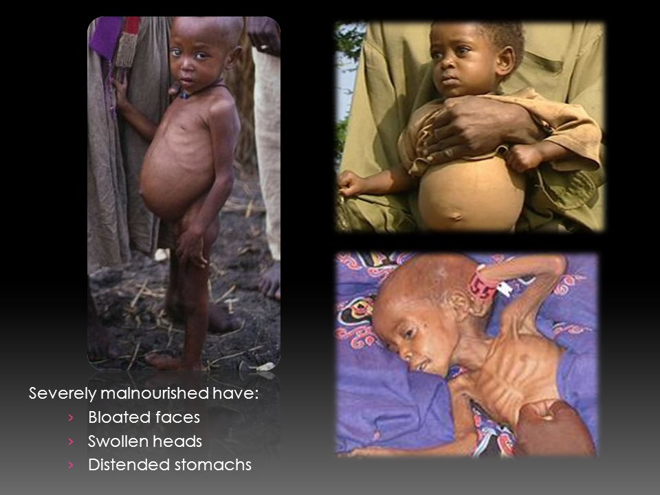 Severely malnourished have: › Bloated faces › Swollen heads › Distended stomachs