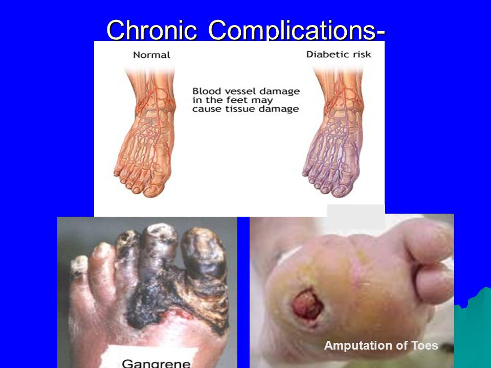 Chronic Complications- Microvascular Amputation of Toes