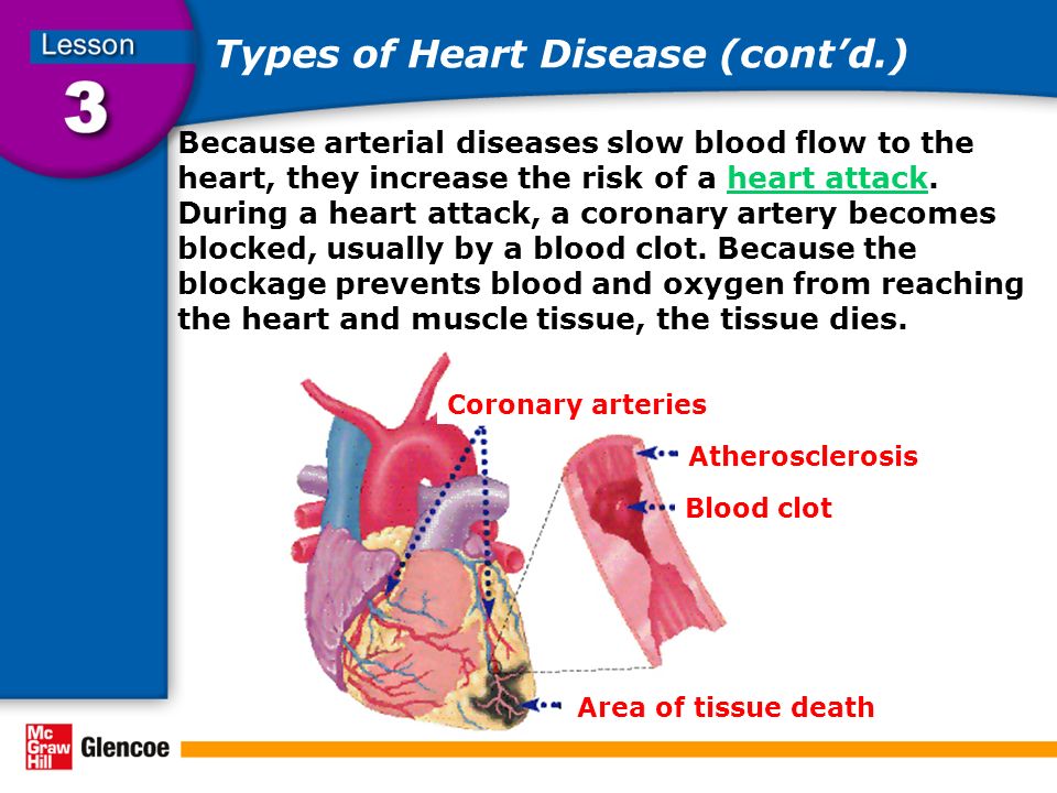 Types of Heart Disease (cont’d.) Because arterial diseases slow blood flow to the heart, they increase the risk of a heart attack.
