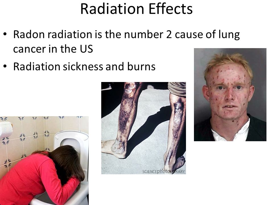 Radiation Effects Radon radiation is the number 2 cause of lung cancer in the US Radiation sickness and burns