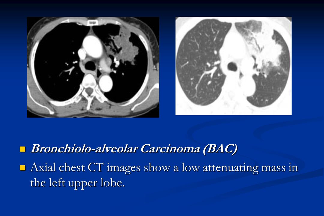 Bronchiolo-alveolar Carcinoma (BAC) Bronchiolo-alveolar Carcinoma (BAC) Axial chest CT images show a low attenuating mass in the left upper lobe.