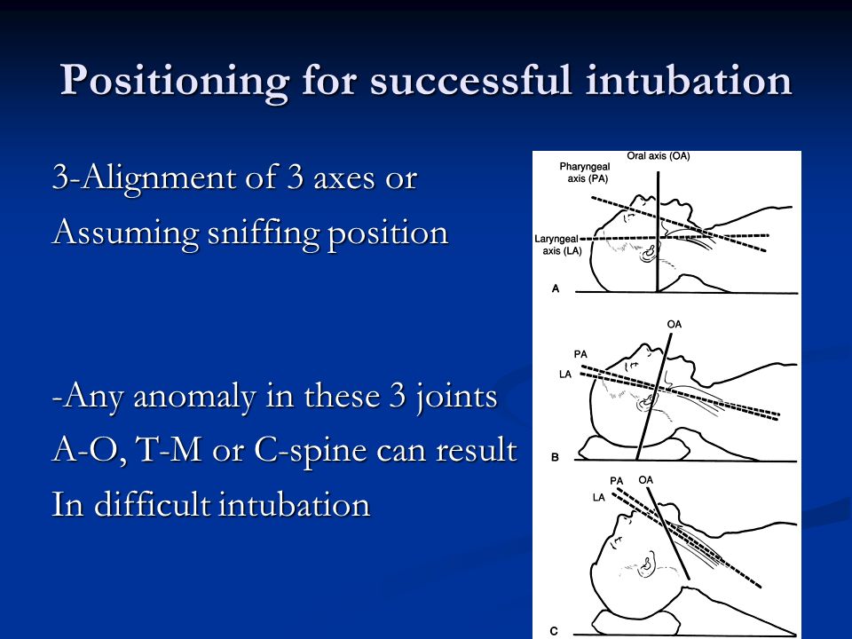 Positioning for successful intubation 3-Alignment of 3 axes or Assuming sniffing position -Any anomaly in these 3 joints A-O, T-M or C-spine can result In difficult intubation