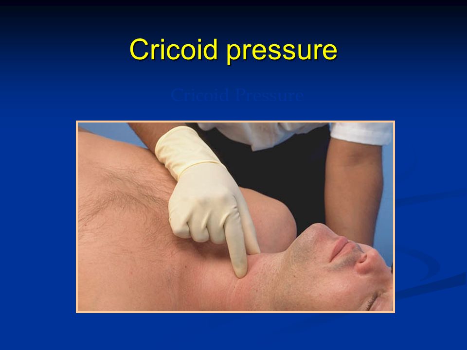 Cricoid pressure Cricoid Pressure