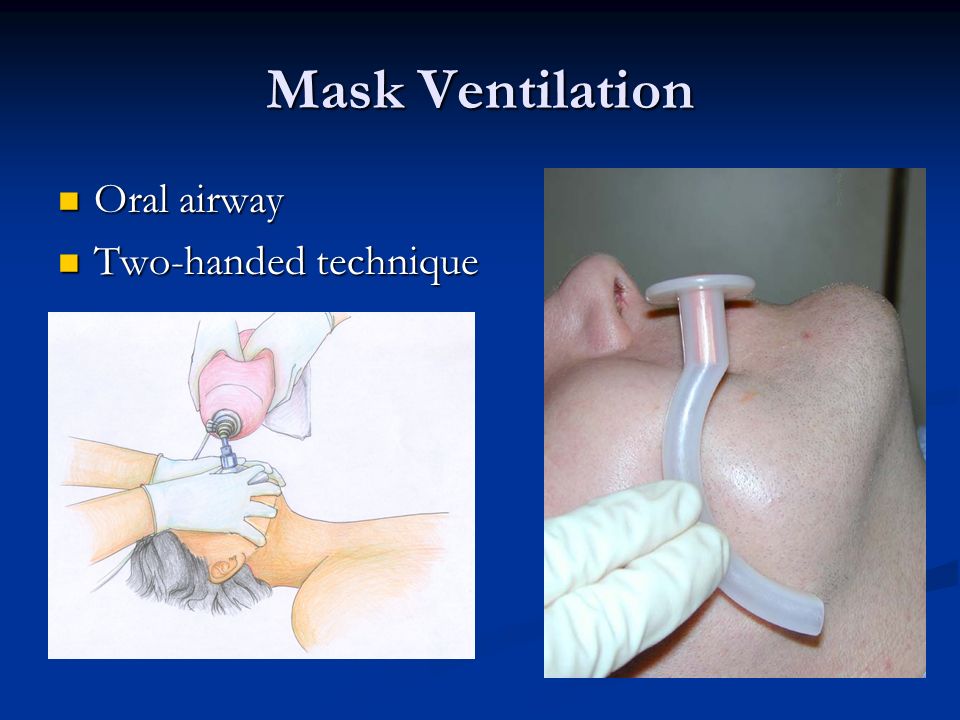 Mask Ventilation Oral airway Oral airway Two-handed technique Two-handed technique