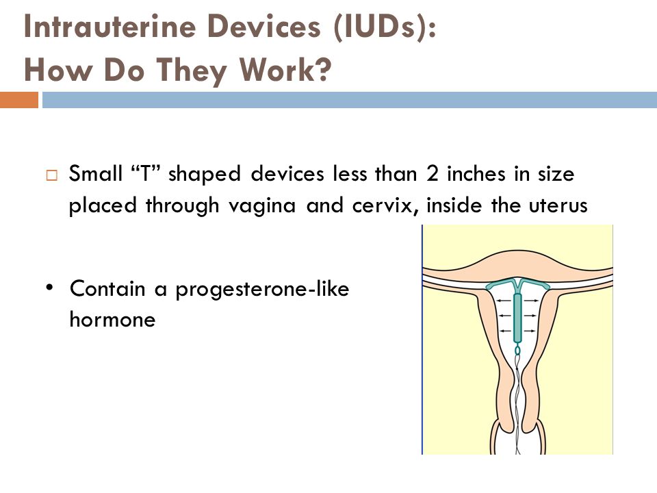 Intrauterine Devices (IUDs): How Do They Work.