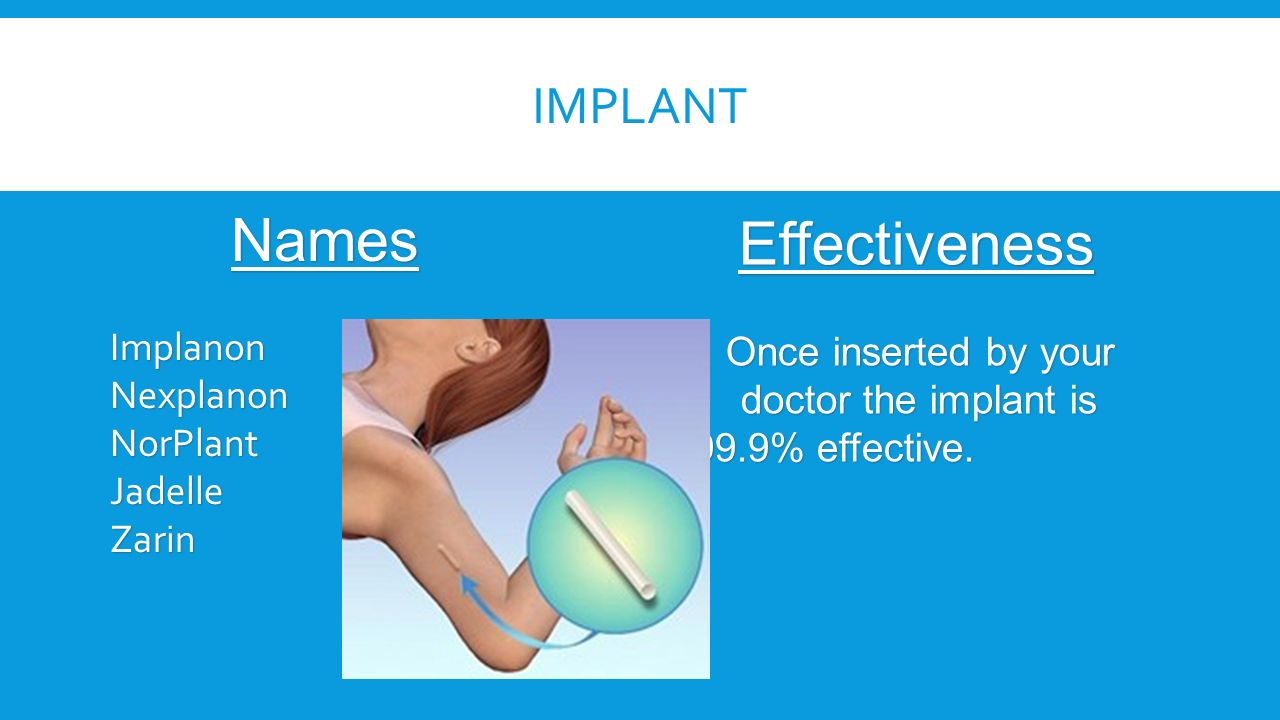 IMPLANT NamesImplanonNexplanonNorPlantJadelleZarin Effectiveness Once inserted by your Once inserted by your doctor the implant is 99.9% effective.