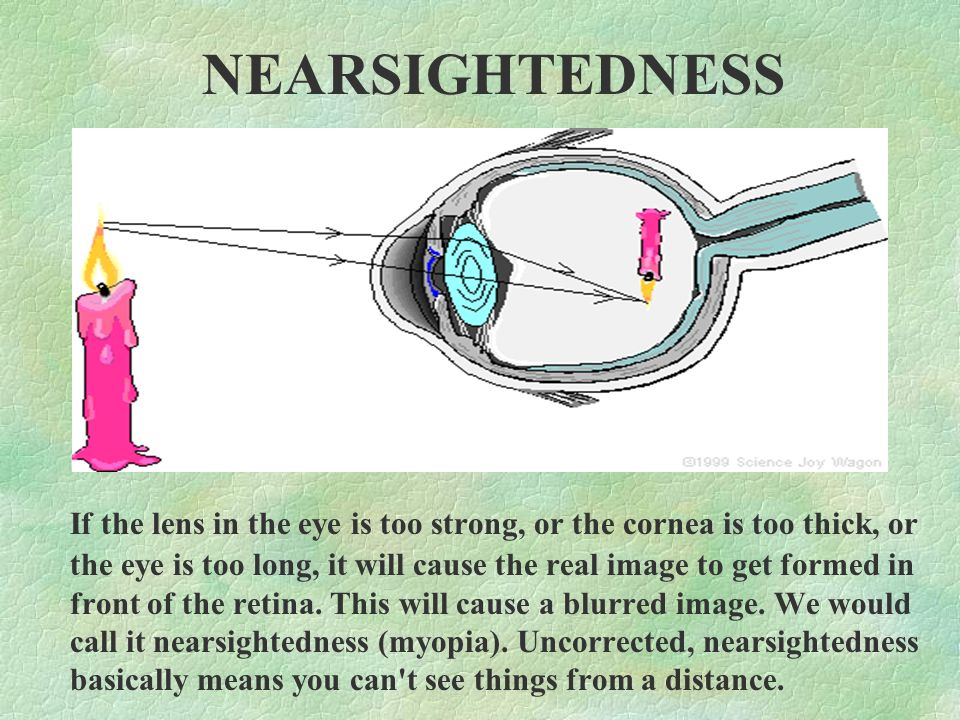 If the lens in the eye is too strong, or the cornea is too thick, or the eye is too long, it will cause the real image to get formed in front of the retina.