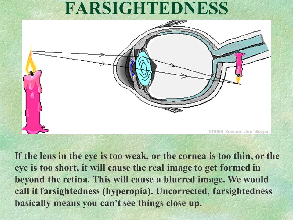 FARSIGHTEDNESS If the lens in the eye is too weak, or the cornea is too thin, or the eye is too short, it will cause the real image to get formed in beyond the retina.