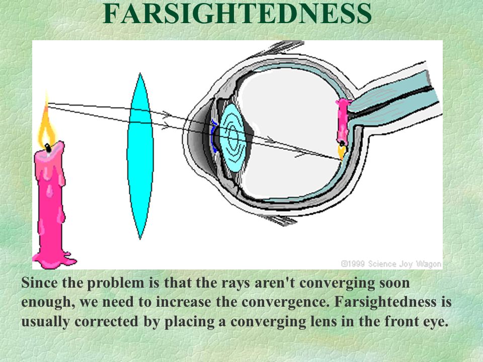 FARSIGHTEDNESS Since the problem is that the rays aren t converging soon enough, we need to increase the convergence.