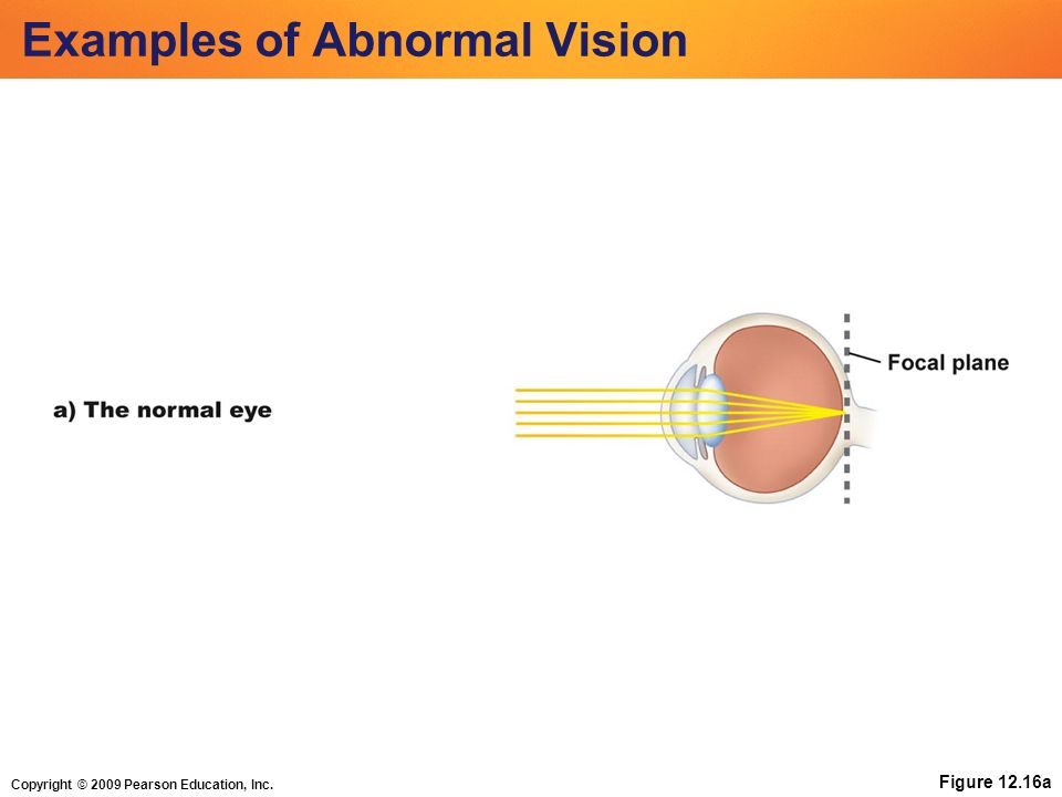 Copyright © 2009 Pearson Education, Inc. Figure 12.16a Examples of Abnormal Vision