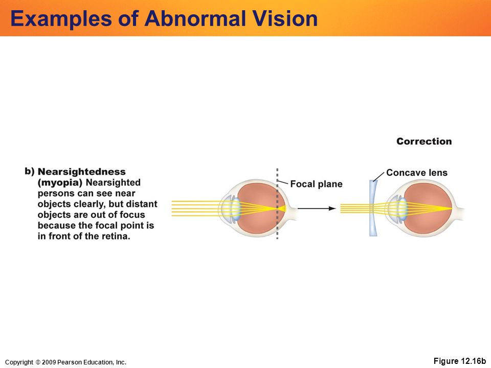 Copyright © 2009 Pearson Education, Inc. Figure 12.16b Examples of Abnormal Vision