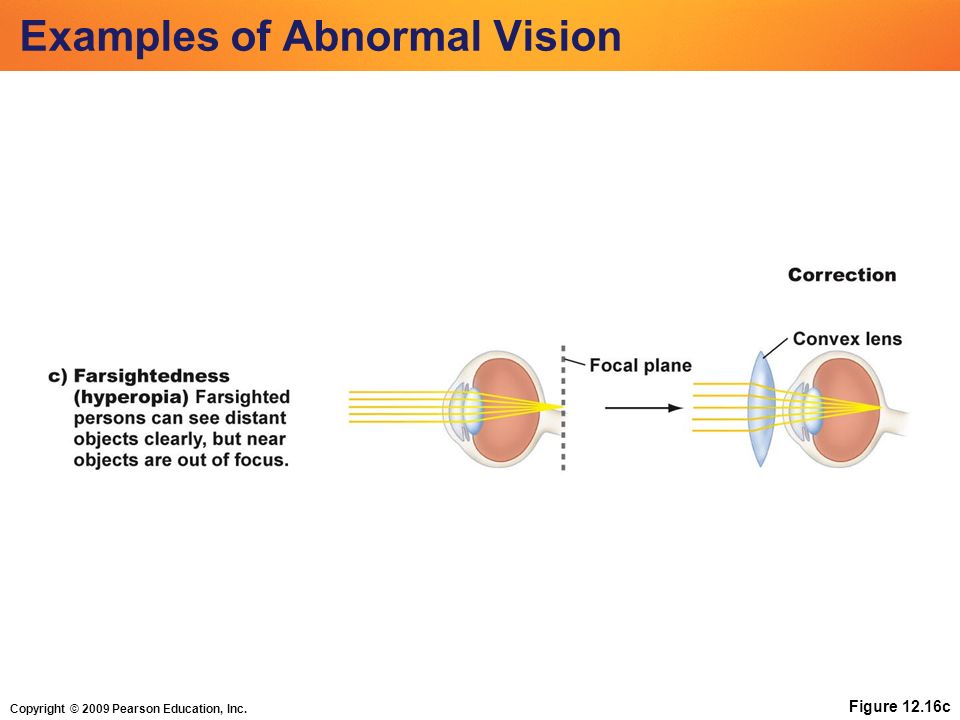 Copyright © 2009 Pearson Education, Inc. Figure 12.16c Examples of Abnormal Vision