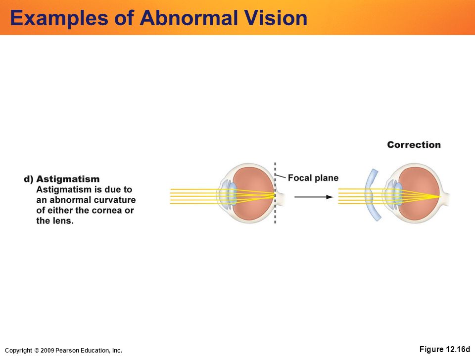 Copyright © 2009 Pearson Education, Inc. Figure 12.16d Examples of Abnormal Vision