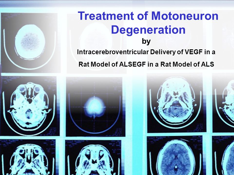 by Intracerebroventricular Delivery of VEGF in a Rat Model of ALSEGF in a Rat Model of ALS Treatment of Motoneuron Degeneration