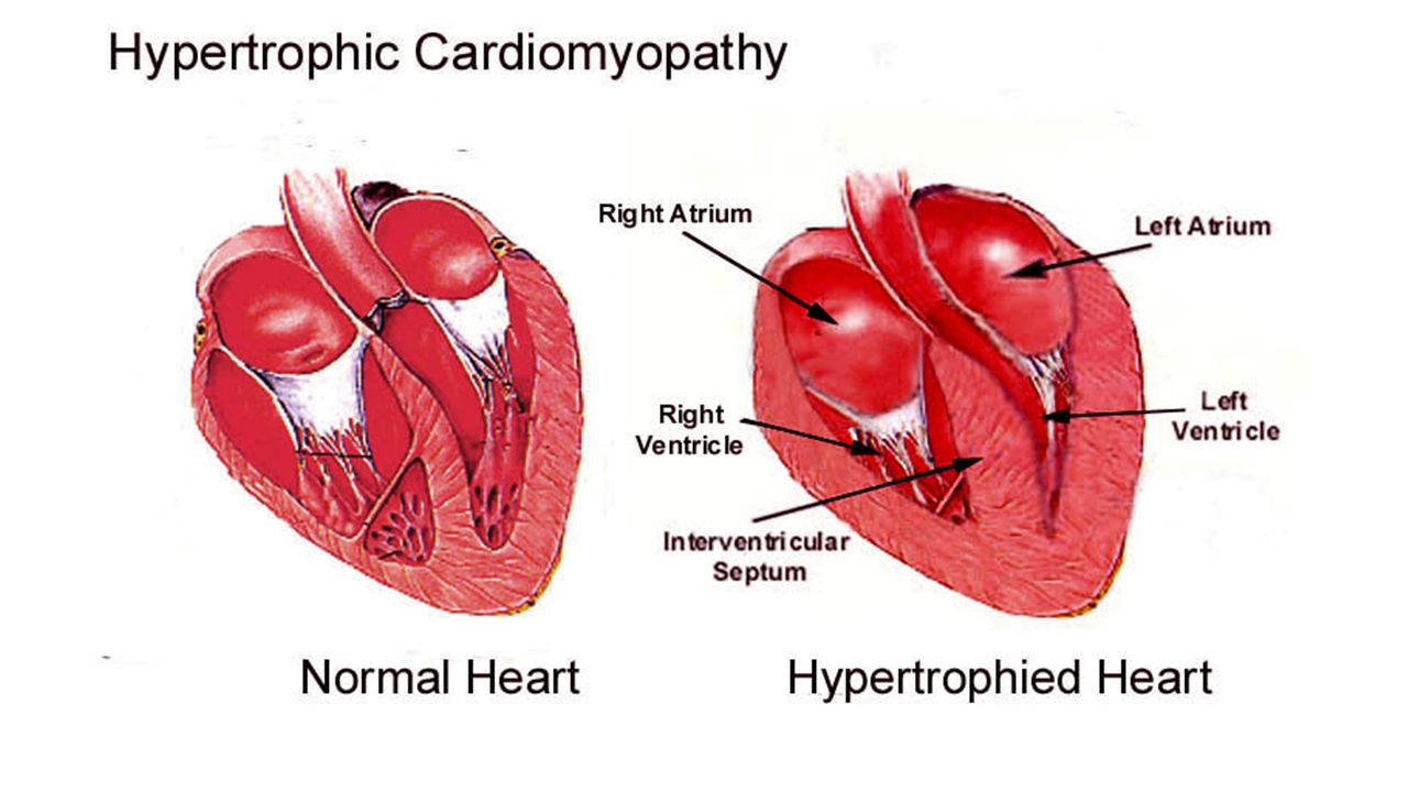 Миокард правого желудочка сердца. Гипертрофированный миокард левого желудочка. Сердце кошки гипертрофическая кардиомиопатия. Нормальное и гипертрофированное сердце.