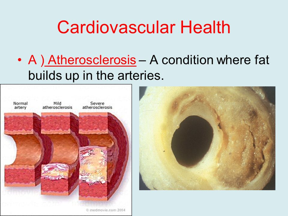 Cardiovascular Health A ) Atherosclerosis – A condition where fat builds up in the arteries.