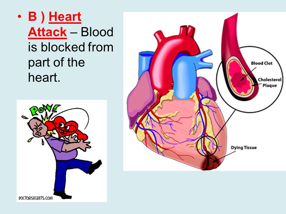 B ) Heart Attack – Blood is blocked from part of the heart.