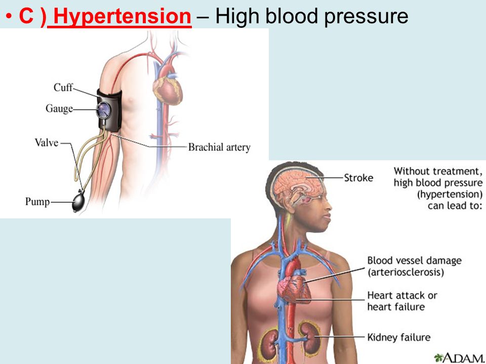 C ) Hypertension – High blood pressure