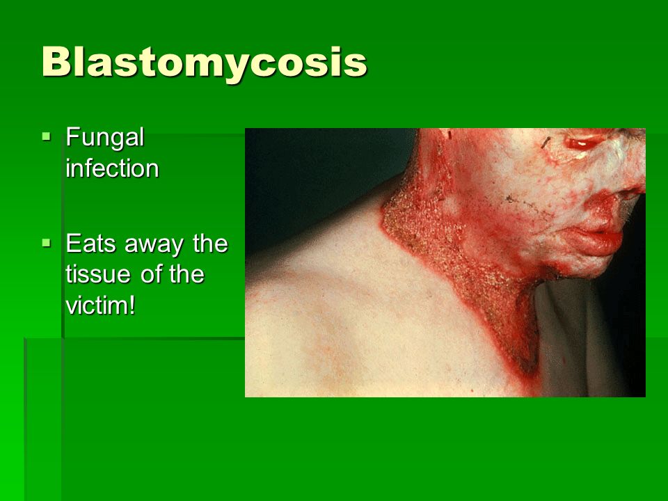 Blastomycosis  Fungal infection  Eats away the tissue of the victim!