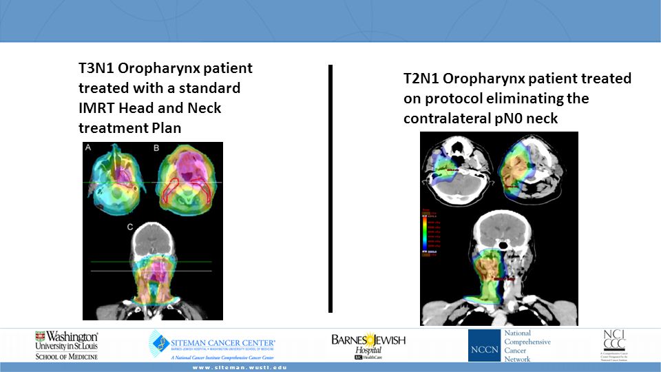 T2N1 Oropharynx patient treated on protocol eliminating the contralateral pN0 neck T3N1 Oropharynx patient treated with a standard IMRT Head and Neck treatment Plan