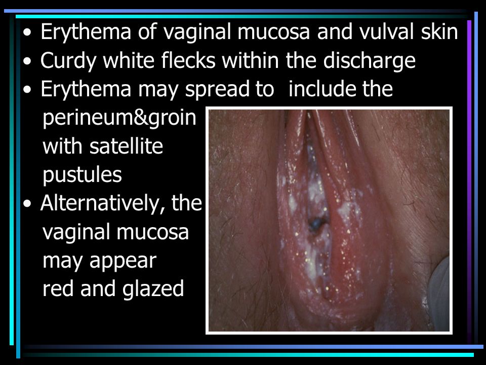 Vaginal Yeast Infection Shown Sing Medical Animation Still Shot