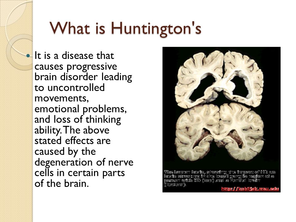 What is Huntington s It is a disease that causes progressive brain disorder leading to uncontrolled movements, emotional problems, and loss of thinking ability.