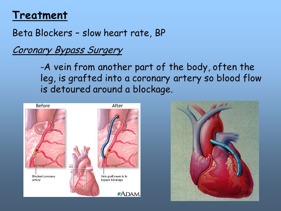 Treatment Beta Blockers – slow heart rate, BP Coronary Bypass Surgery -A vein from another part of the body, often the leg, is grafted into a coronary artery so blood flow is detoured around a blockage.