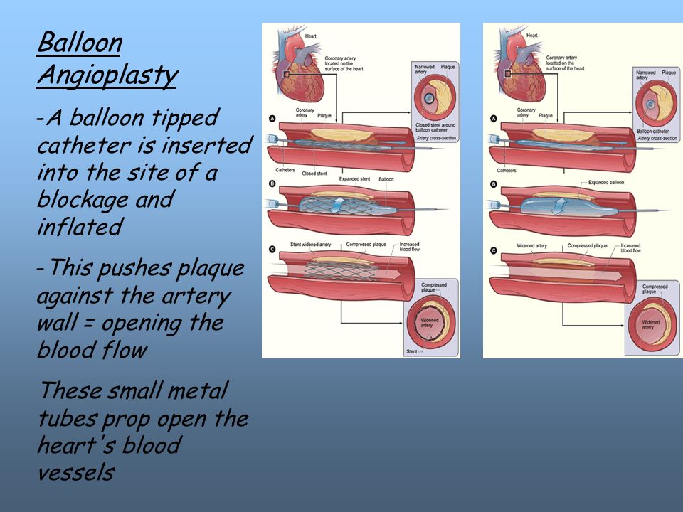 Balloon Angioplasty -A balloon tipped catheter is inserted into the site of a blockage and inflated -This pushes plaque against the artery wall = opening the blood flow These small metal tubes prop open the heart s blood vessels
