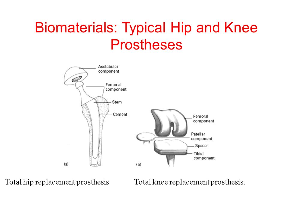 Biomaterials: Typical Hip and Knee Prostheses Total hip replacement prosthesis Total knee replacement prosthesis.