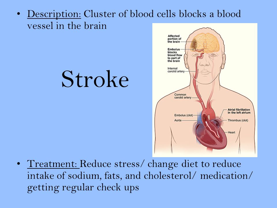 Description: Cluster of blood cells blocks a blood vessel in the brain Stroke Treatment: Reduce stress/ change diet to reduce intake of sodium, fats, and cholesterol/ medication/ getting regular check ups
