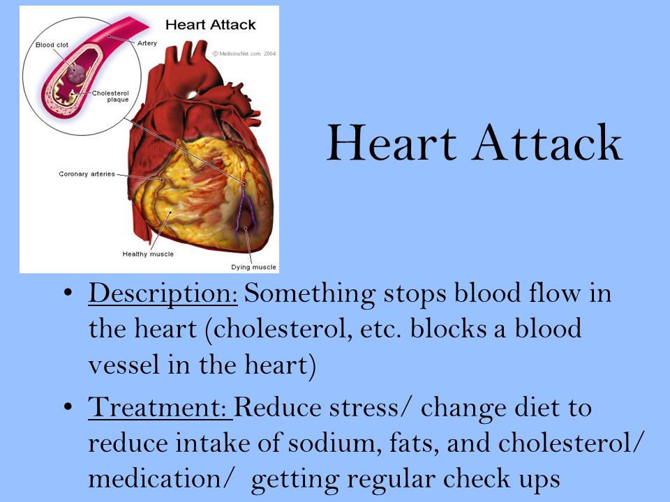 Heart Attack Description: Something stops blood flow in the heart (cholesterol, etc.