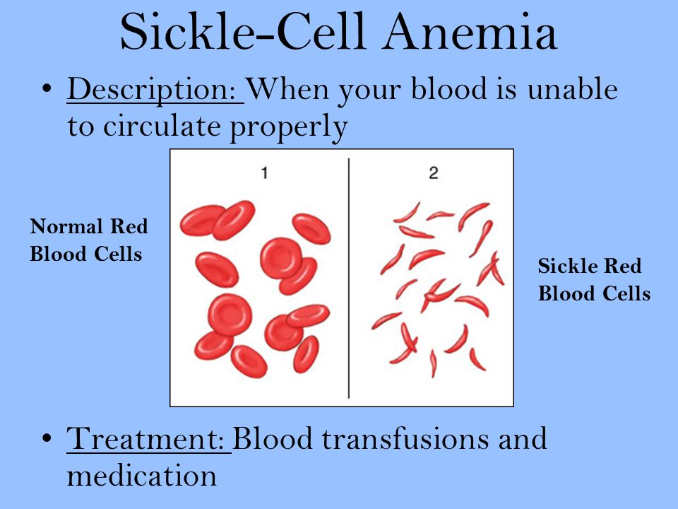 Sickle-Cell Anemia Description: When your blood is unable to circulate properly Treatment: Blood transfusions and medication Normal Red Blood Cells Sickle Red Blood Cells