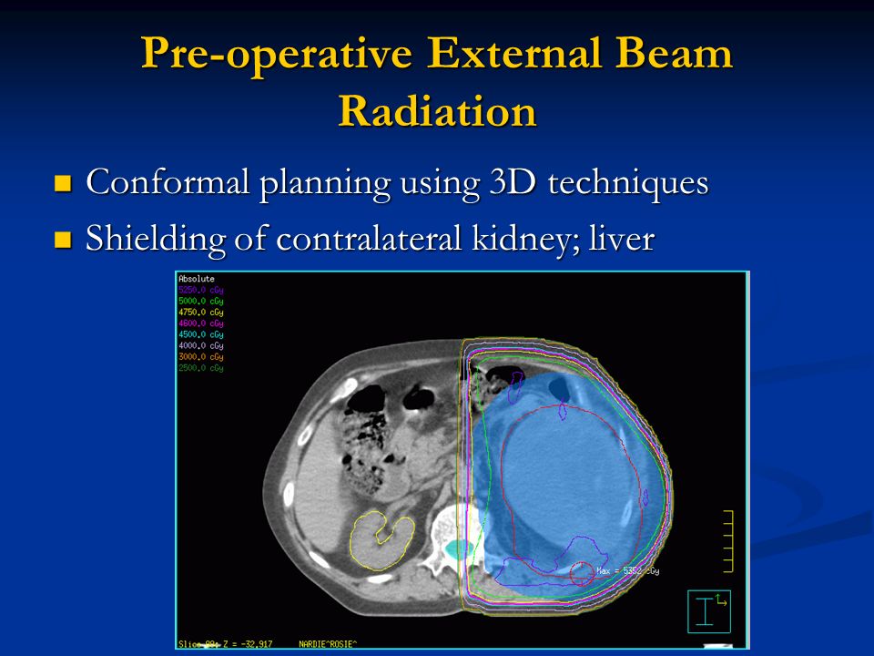 Pre-operative External Beam Radiation Conformal planning using 3D techniques Conformal planning using 3D techniques Shielding of contralateral kidney; liver Shielding of contralateral kidney; liver
