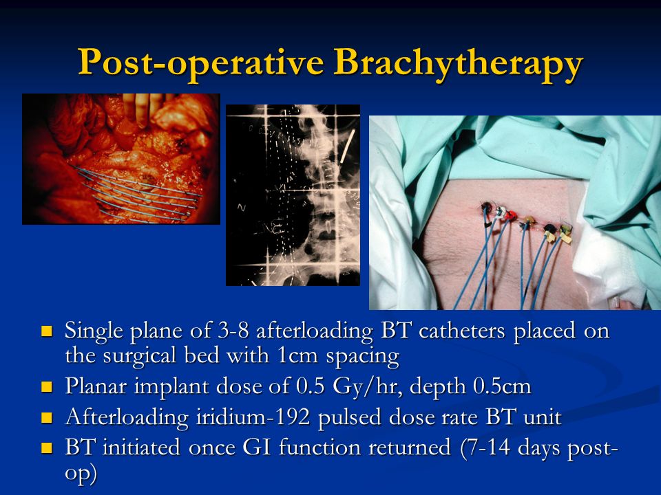 Post-operative Brachytherapy Single plane of 3-8 afterloading BT catheters placed on the surgical bed with 1cm spacing Single plane of 3-8 afterloading BT catheters placed on the surgical bed with 1cm spacing Planar implant dose of 0.5 Gy/hr, depth 0.5cm Planar implant dose of 0.5 Gy/hr, depth 0.5cm Afterloading iridium-192 pulsed dose rate BT unit Afterloading iridium-192 pulsed dose rate BT unit BT initiated once GI function returned (7-14 days post- op) BT initiated once GI function returned (7-14 days post- op)