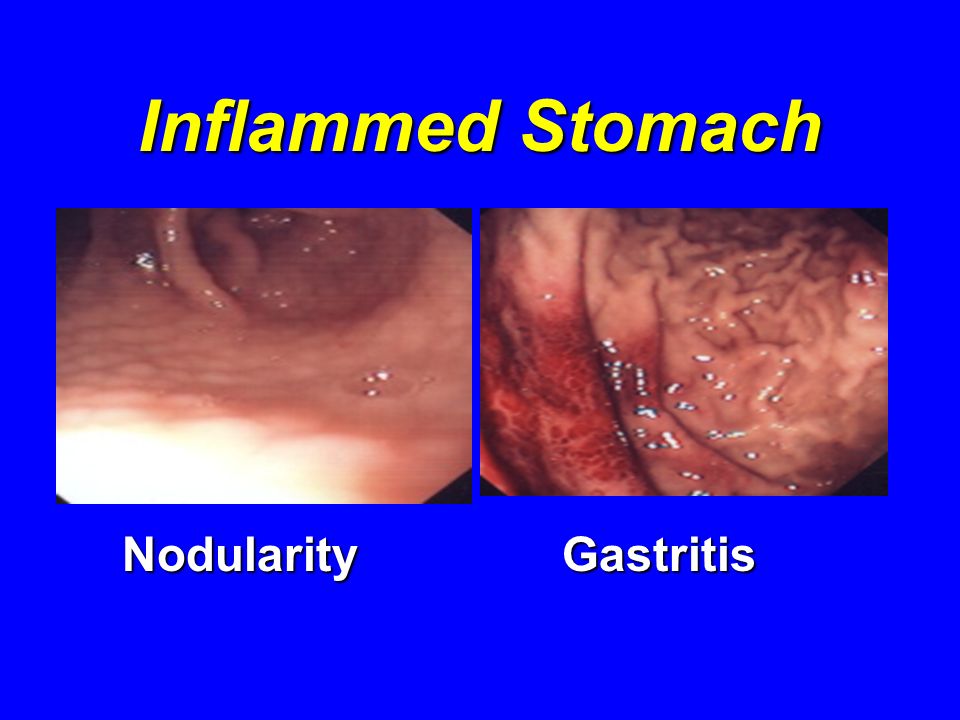 Inflammed Stomach NodularityGastritis NodularityGastritis
