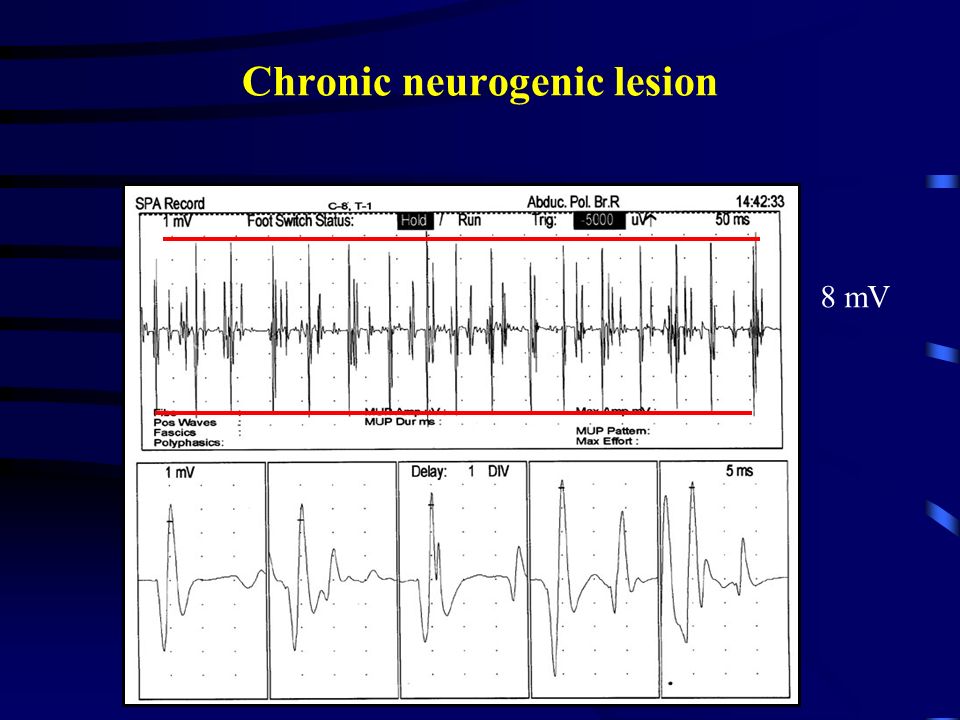 Neuromuscular Diseases Radim Mazanec, MD, Ph.D Department of Neurology. -  ppt download