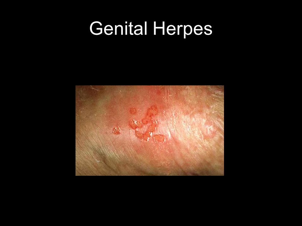 cyst sebaceous vagina Parkland students porn
